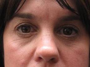 after eyelid lift female patient front view case 2929