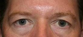 before eyelid lift male patient front view case 2936