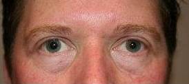 after eyelid lift male patient front view case 2936