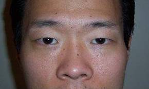 before eyelid lift male patient front view case 2939