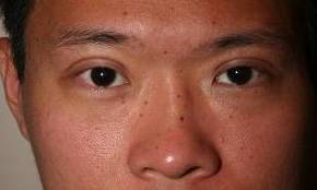 after eyelid lift male patient front view case 2939