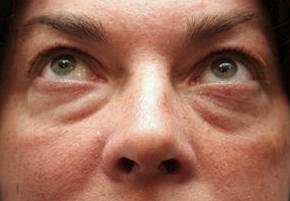 before eyelid lift female patient front view case 2942