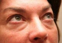 before eyelid lift female patient right angled view case 2942