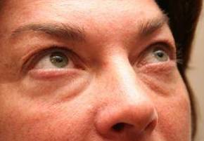 before eyelid lift female patient right angled view case 2942