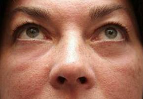 after eyelid lift female patient front view case 2942