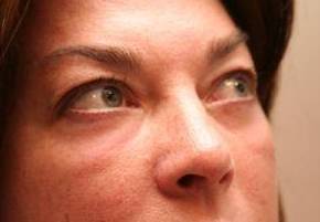 after eyelid lift female patient right angled view case 2942