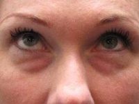 before eyelid lift female patient front view case 2947