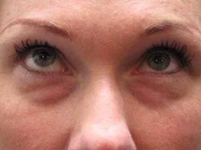 before eyelid lift female patient front view case 2947