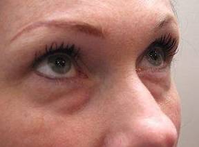 before eyelid lift female patient right angled view case 2947