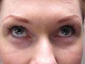after eyelid lift female patient front view case 2947