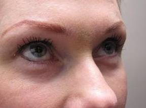 after eyelid lift female patient right angled view case 2947