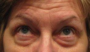 before eyelid lift female patient looking up view case 2952