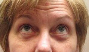 after eyelid lift female patient looking up view case 2952