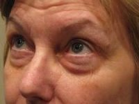 after eyelid lift female patient left angled view case 2952