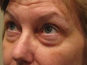 after eyelid lift female patient left angled view case 2952