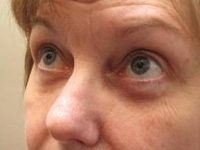after eyelid lift female patient left angled view case 2952