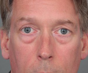 before eyelid lift male patient front view case 2957