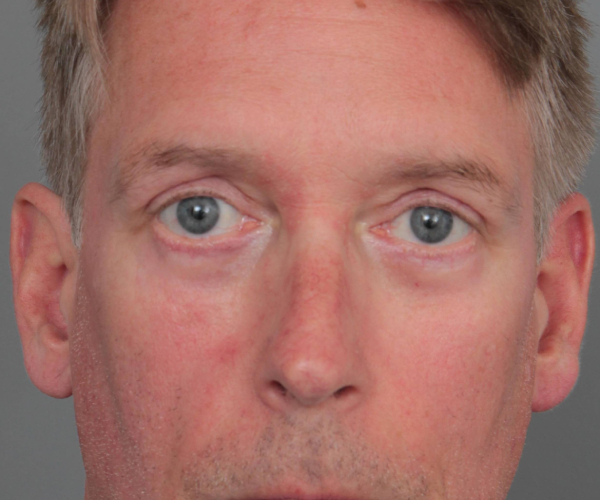 after eyelid lift male patient front view case 2957