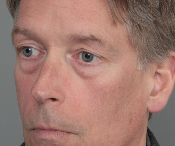 before eyelid lift male patient left angled view case 2957