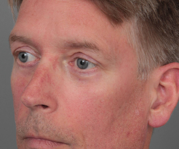 after eyelid lift male patient left angled view case 2957