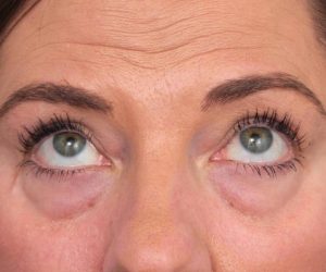 before eyelid lift female patient front view case 2967