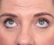 after eyelid lift female patient front view case 2967
