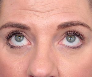 after eyelid lift female patient front view case 2967