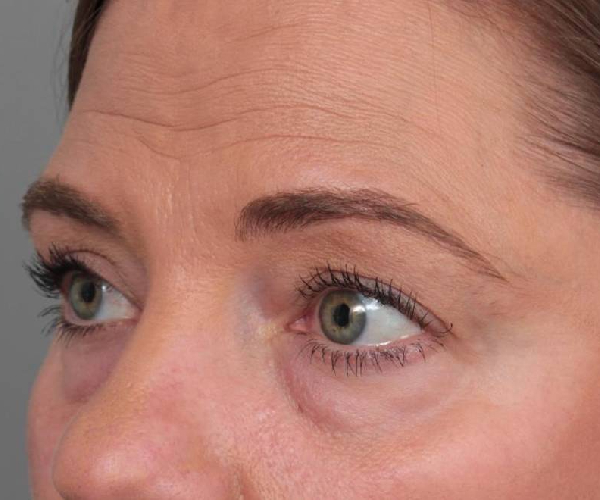 before eyelid lift female patient left angled view case 2967