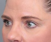 after eyelid lift female patient left angled view case 2967