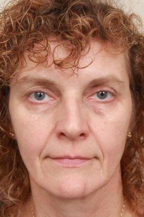 before facelift | neck lift female patient front view case 3521