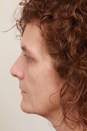 before facelift | neck lift female patient left side view case 3521