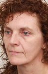 before facelift | neck lift female patient left angled view case 3521