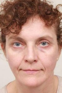 after facelift | neck lift female patient front view case 3521