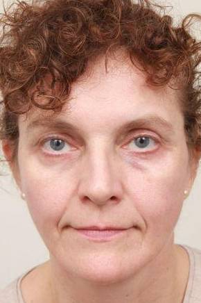 after facelift | neck lift female patient front view case 3521