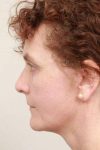 after facelift | neck lift female patient left side view case 3521