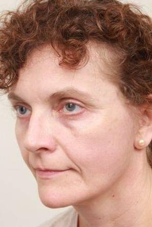after facelift | neck lift female patient left angled view case 3521