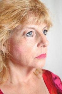 before facelift | neck lift female patient right angled view case 3623