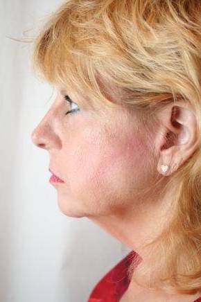 before facelift | neck lift female patient left side view case 3623