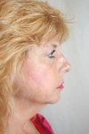 before facelift | neck lift female patient right side view case 3623
