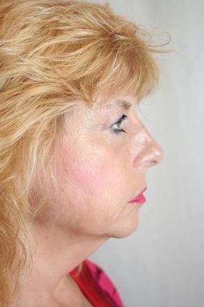 before facelift | neck lift female patient right side view case 3623