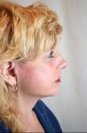 after facelift | neck lift female patient right side view case 3623