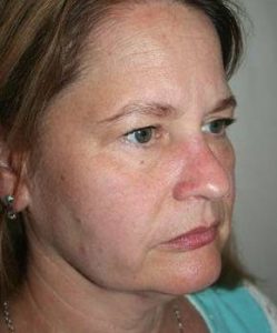 before facelift | neck lift female patient right angled view case 3636