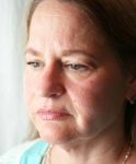 before facelift | neck lift female patient left angled view case 3636