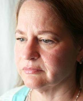 before facelift | neck lift female patient left angled view case 3636