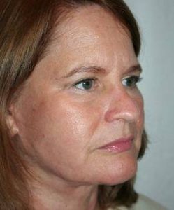 after facelift | neck lift female patient right angled view case 3636