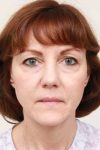 before facelift | neck lift female patient front view case 3641