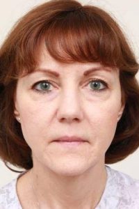 before facelift | neck lift female patient front view case 3641