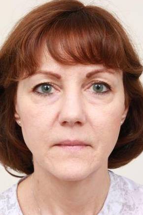 before facelift | neck lift female patient front view case 3641