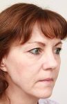 before facelift | neck lift female patient right angled view case 3641