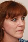 after facelift | neck lift female patient right angled view case 3641